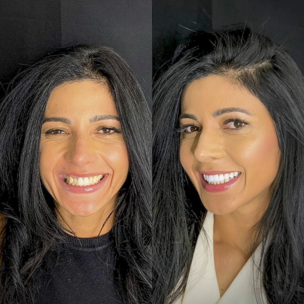 Antes e depois de tratamento dental na Odonto Rir