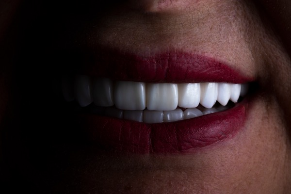 Lentes de contato dental na Odonto Rir