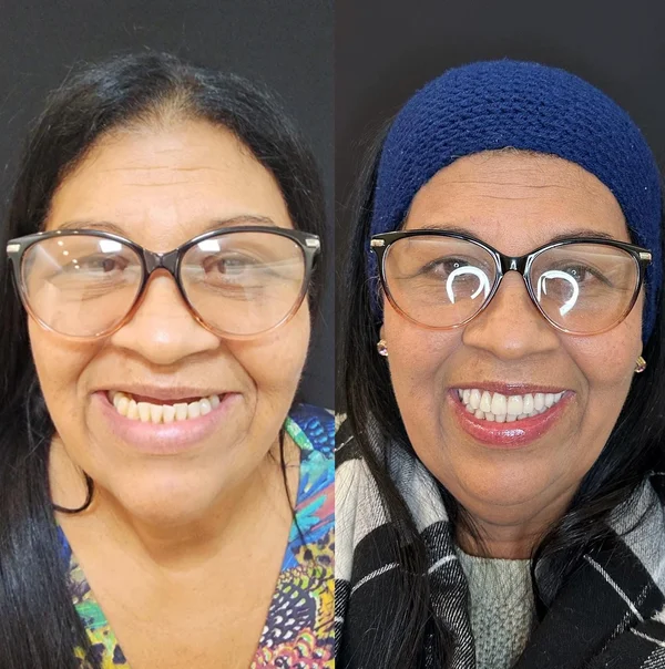 Antes e depois de implante dentário na Odonto Rir
