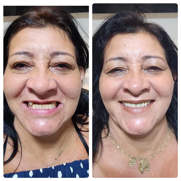 Antes e depois de implante dentário na Odonto Rir