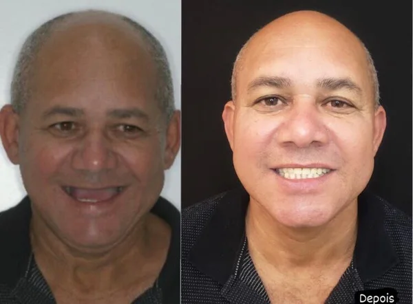 Seu Roberto, antes e depois do implante dentário na Odonto Rir