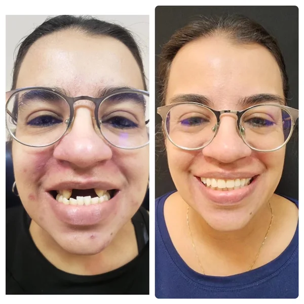 Fernanda, antes e depois do implante dentário na Odonto Rir