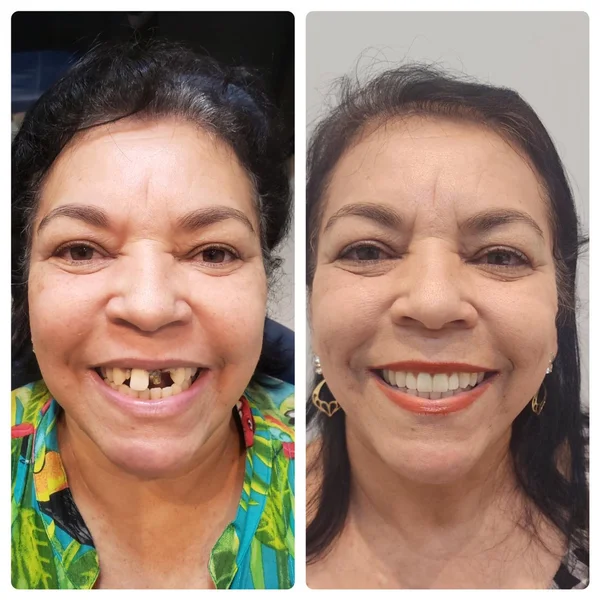 Dona Neide, antes e depois do implante dentário na Odonto Rir