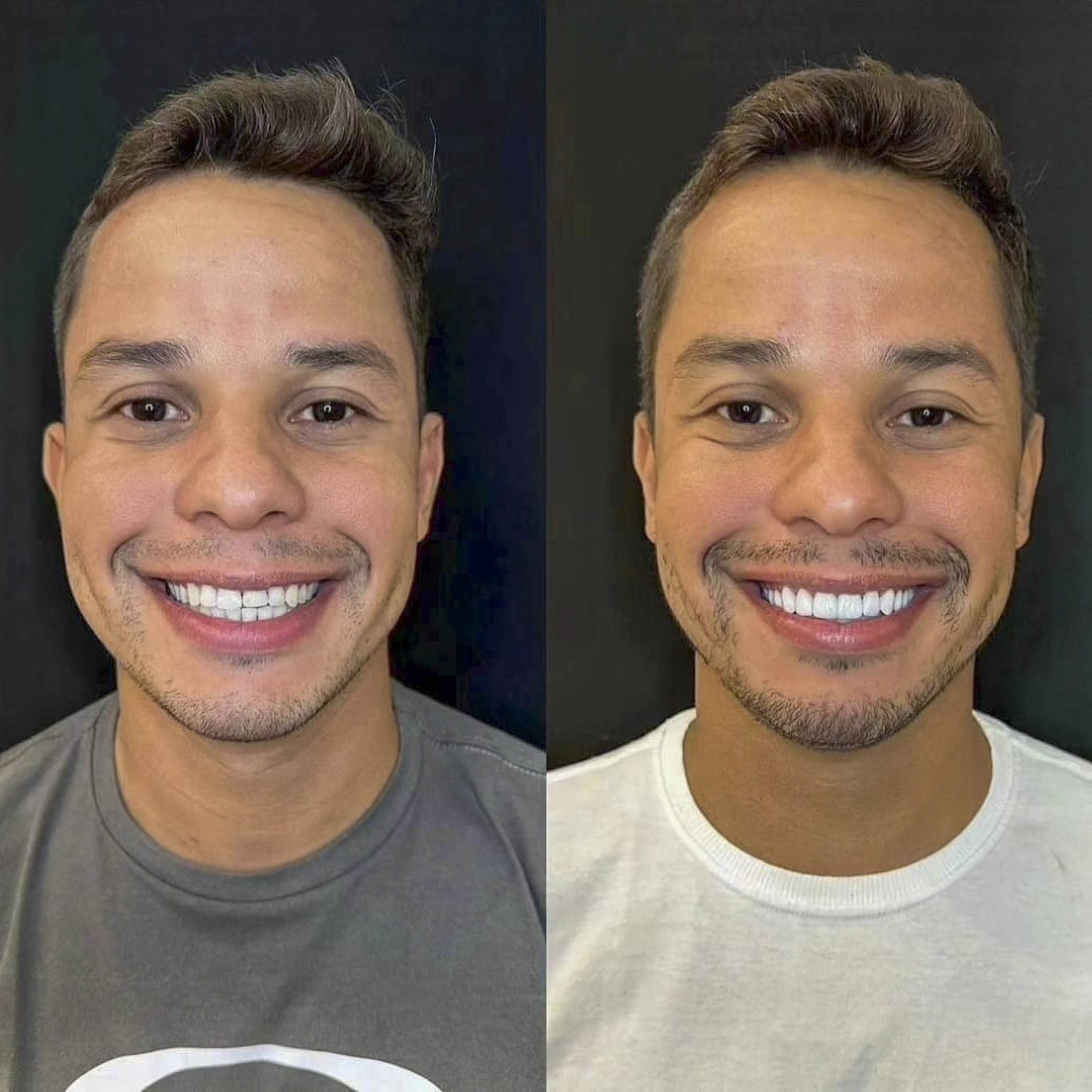 Antes e depois de lentes de contato dental na Odonto Rir