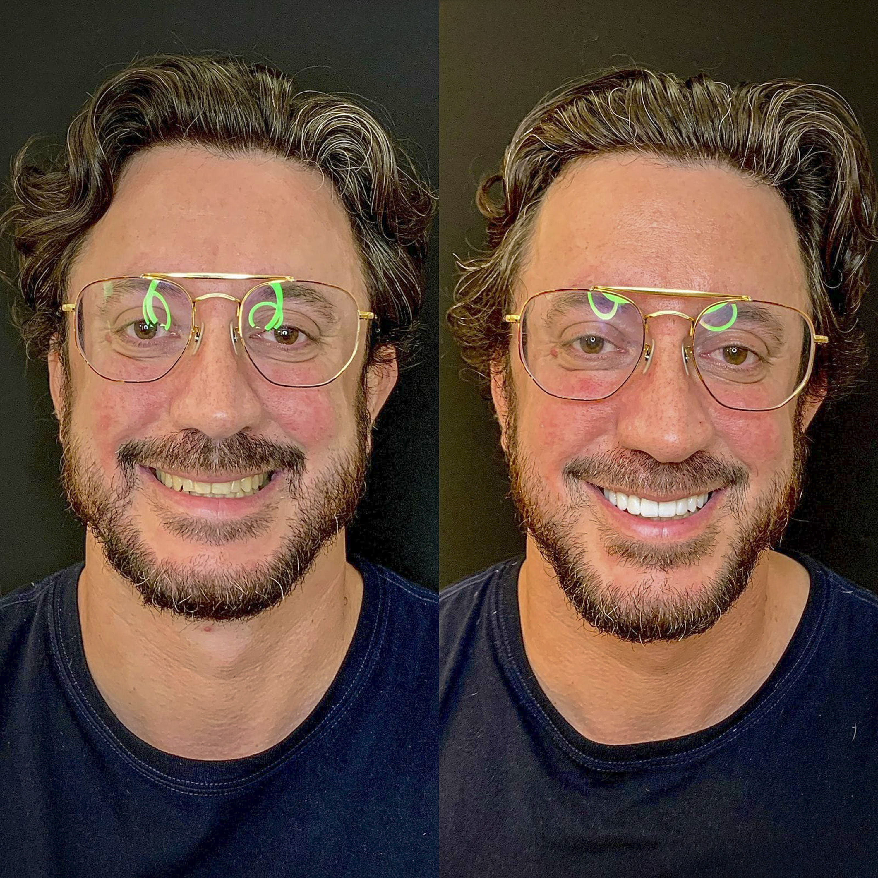 Antes e depois de lentes de contato dental na Odonto Rir